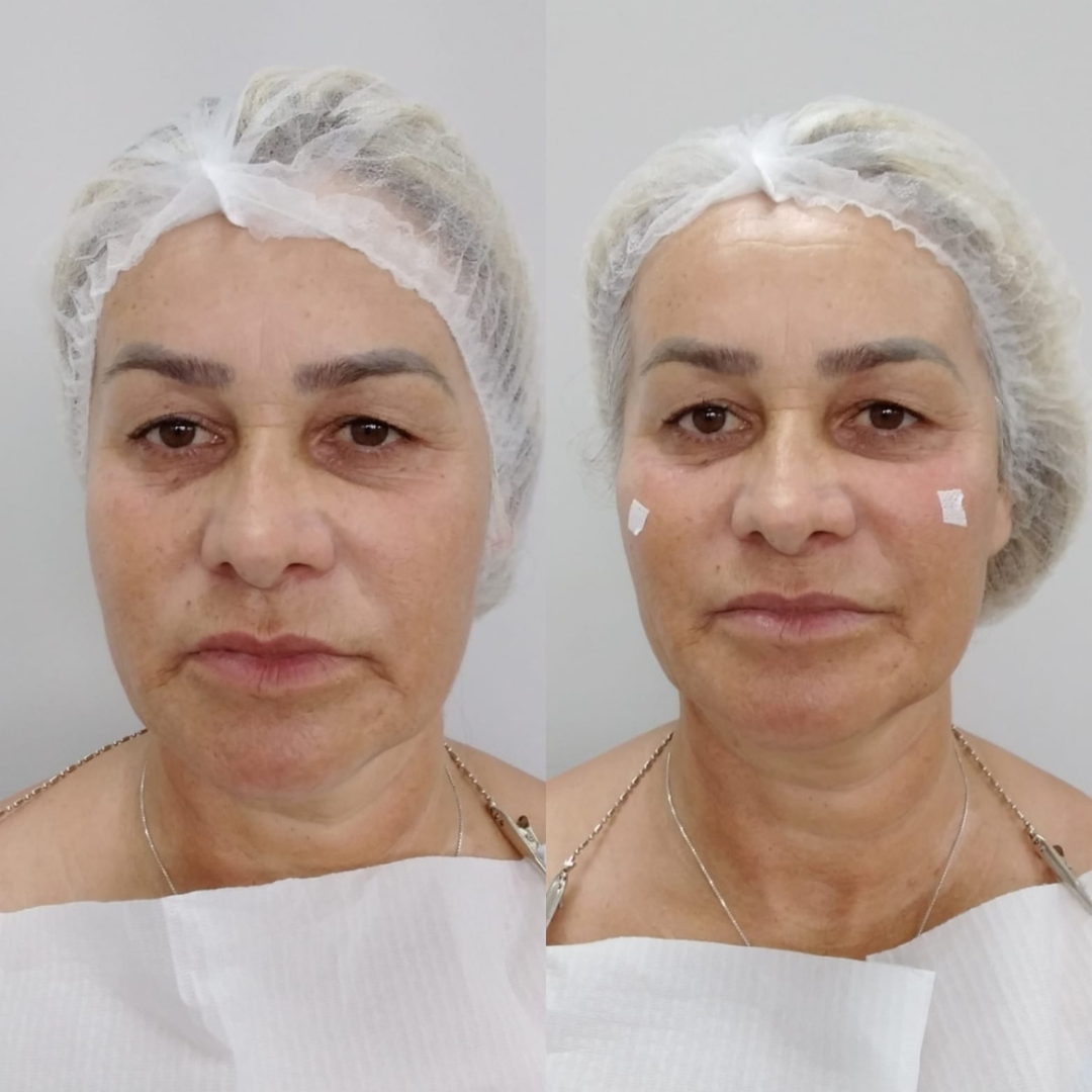 Fios de Sustentação