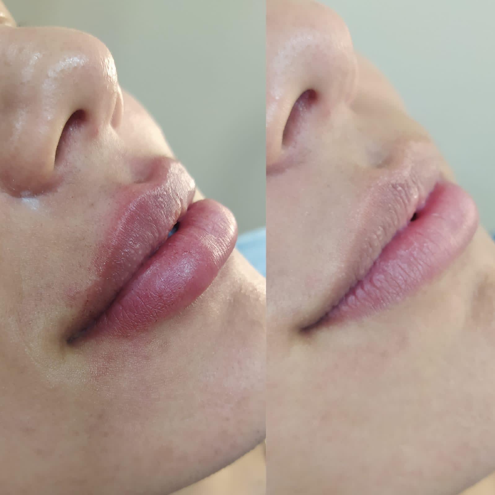 Preenchimento Labial